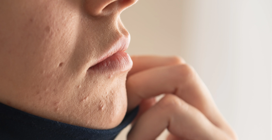 Microneedling for Acne Scars: How Effective Is It?
