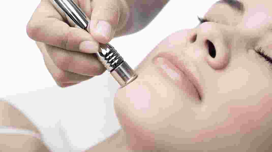 The skin concerns that will benefit from a Microdermabrasion