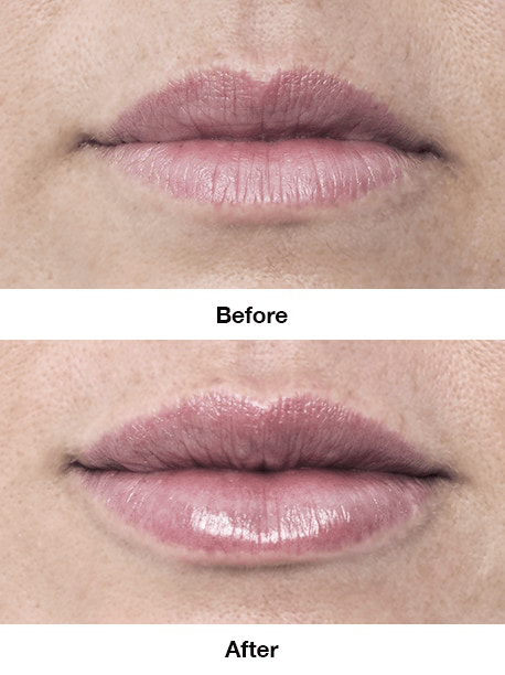 Lips Borders Volume